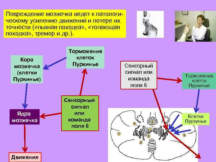 Повреждение мозжечка ведет к патологическому усилению движений и потере их точности ( «пьяная походка»
