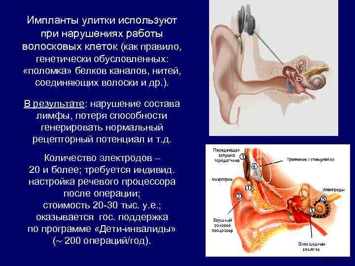 Импланты улитки используют при нарушениях работы волосковых клеток (как правило, генетически обусловленных: «поломка» белков