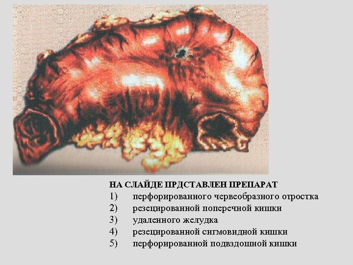 НА СЛАЙДЕ ПРДСТАВЛЕН ПРЕПАРАТ 1) 2) 3) 4) 5) перфорированного червеобразного отростка резецированной поперечной
