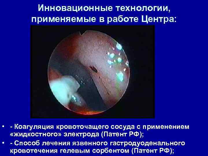 Инновационные технологии, применяемые в работе Центра: • - Коагуляция кровоточащего сосуда с применением «жидкостного»