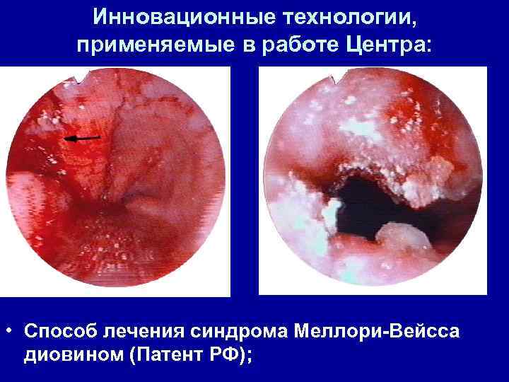 Инновационные технологии, применяемые в работе Центра: • Способ лечения синдрома Меллори-Вейсса диовином (Патент РФ);