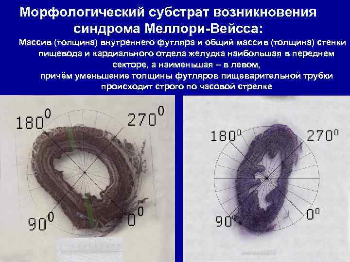 Морфологический субстрат возникновения синдрома Меллори-Вейсса: Массив (толщина) внутреннего футляра и общий массив (толщина) стенки