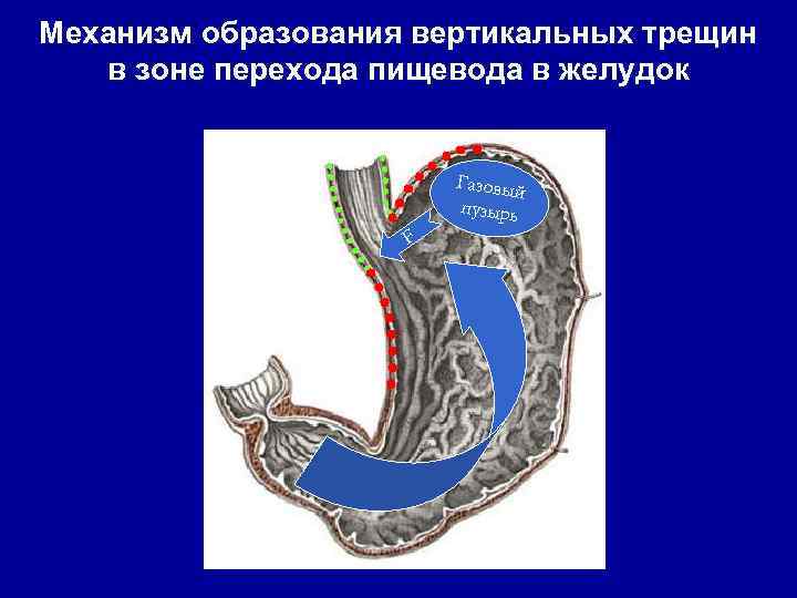 Механизм образования вертикальных трещин в зоне перехода пищевода в желудок Газовый пузырь F 