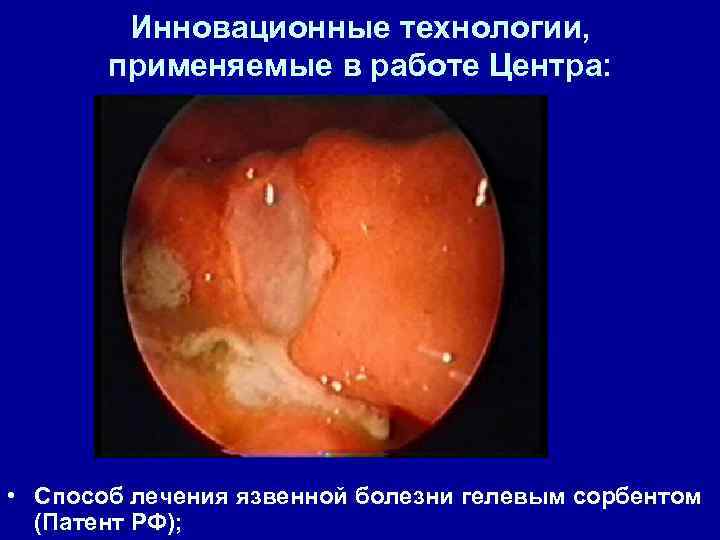 Инновационные технологии, применяемые в работе Центра: • Способ лечения язвенной болезни гелевым сорбентом (Патент