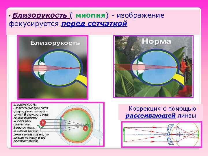 Близорукость ( миопия) - изображение фокусируется перед сетчаткой • Коррекция с помощью рассеивающей линзы