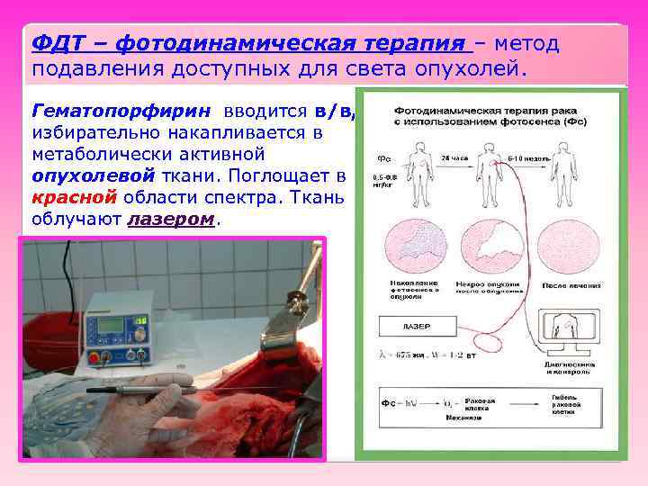 ФДТ – фотодинамическая терапия – метод подавления доступных для света опухолей. Гематопорфирин вводится в/в,