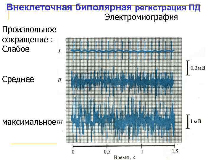 Внеклеточная биполярная регистрация ПД Электромиография Произвольное сокращение : Слабое Среднее максимальное 