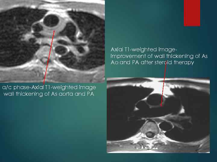 Axial T 1 -weighted imageimprovement of wall thickening of As Ao and PA after