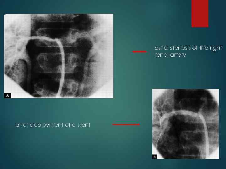ostial stenosis of the right renal artery after deployment of a stent 