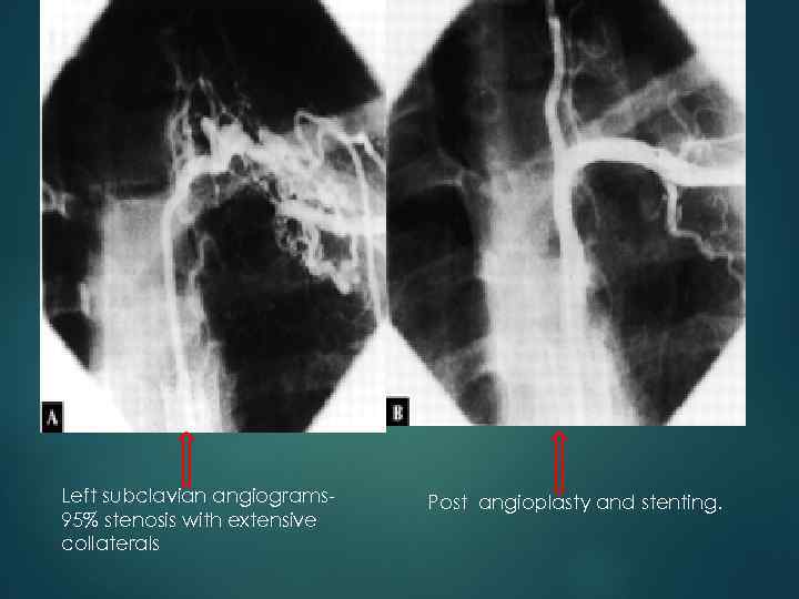 Left subclavian angiograms 95% stenosis with extensive collaterals Post angioplasty and stenting. 