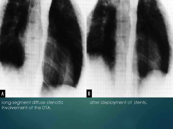 long-segment diffuse stenotic involvement of the DTA after deployment of stents. 