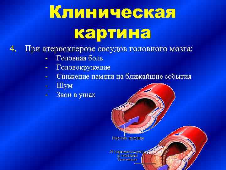 Клиническая картина 4. При атеросклерозе сосудов головного мозга: - Головная боль Головокружение Снижение памяти