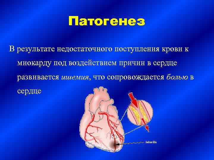 Патогенез В результате недостаточного поступления крови к миокарду под воздействием причин в сердце развивается