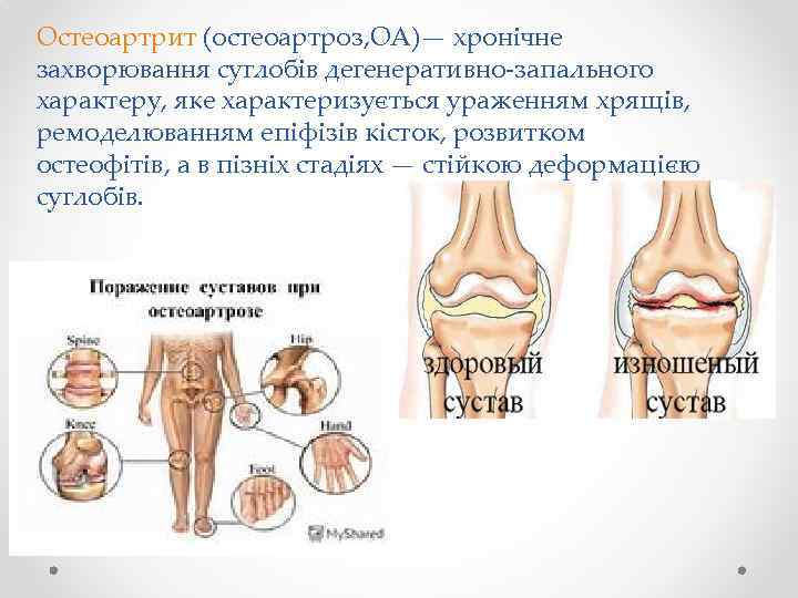 Остеоартрит (остеоартроз, ОА)— хронічне захворювання суглобів дегенеративно запального характеру, яке характеризується ураженням хрящів, ремоделюванням