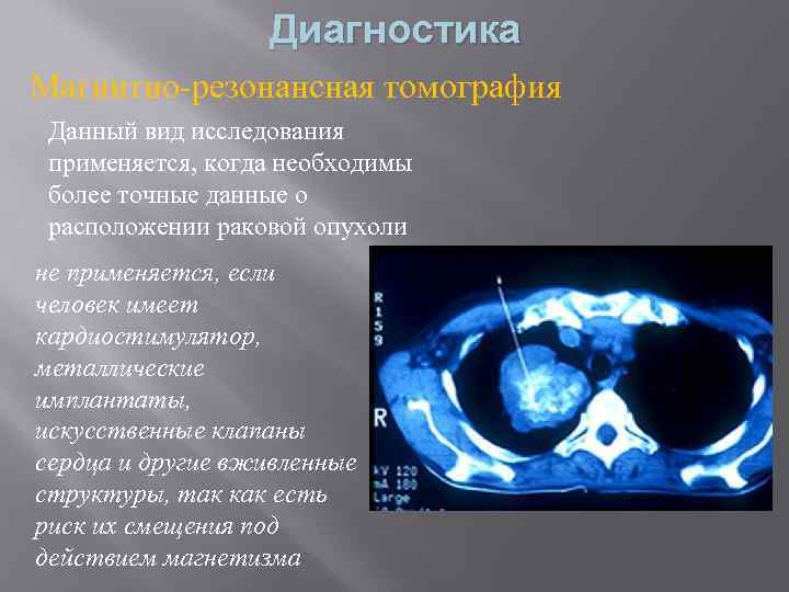 Диагностика Магнитно-резонансная томография Данный вид исследования применяется, когда необходимы более точные данные о расположении
