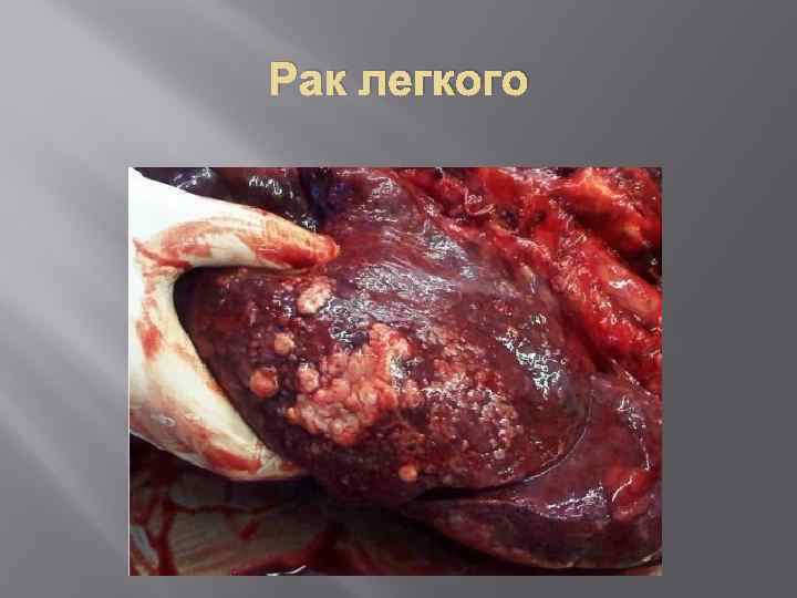 Рак легкого 