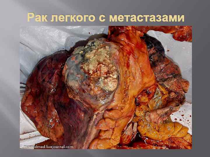 Рак легкого с метастазами 