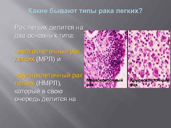 Какие бывают типы рака легких? Рак легких делится на два основных типа: -мелкоклеточный рак
