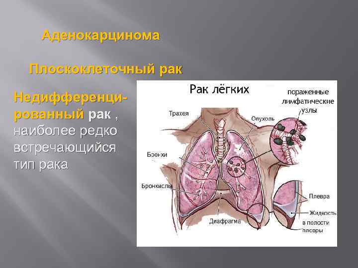 Аденокарцинома Плоскоклеточный рак Недифференцированный рак , наиболее редко встречающийся тип рака 