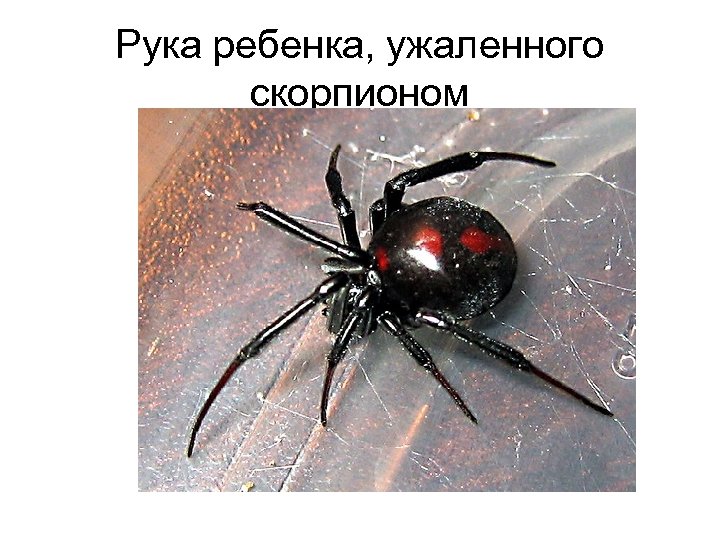 Рука ребенка, ужаленного скорпионом 