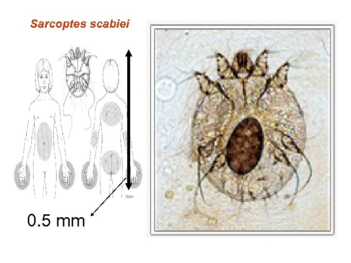 Sarcoptes scabiei 0. 5 mm 