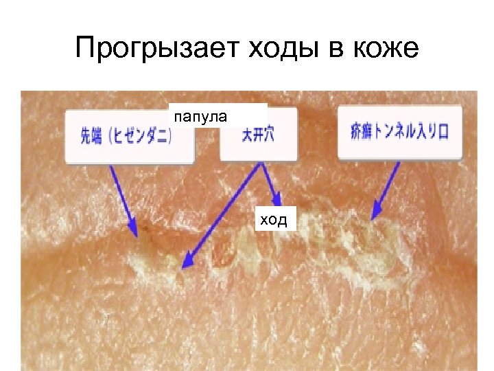 Прогрызает ходы в коже папула ход 