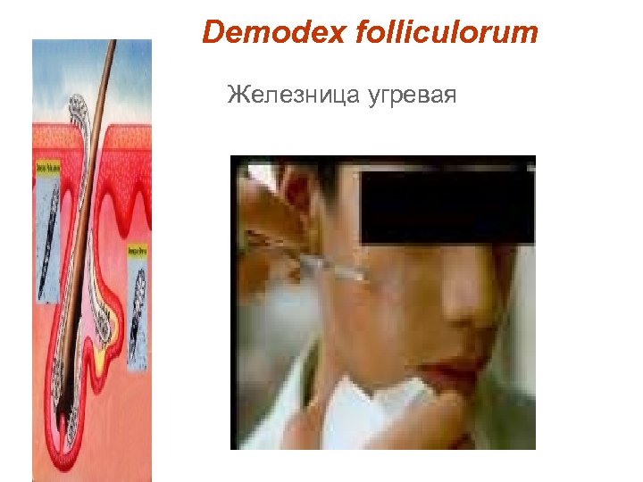 Demodex folliculorum Железница угревая 
