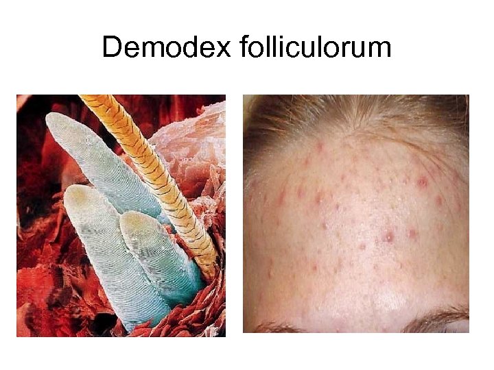 Demodex folliculorum 