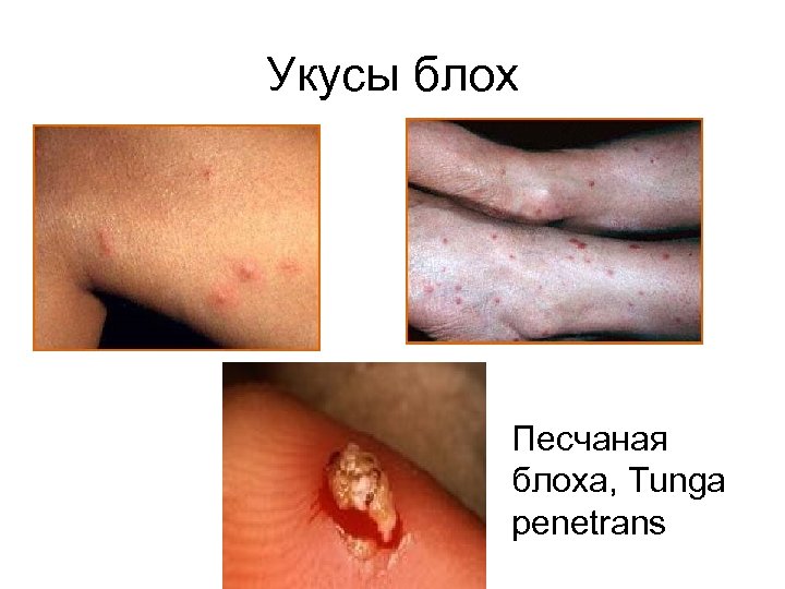 Укусы блох Песчаная блоха, Tunga penetrans 