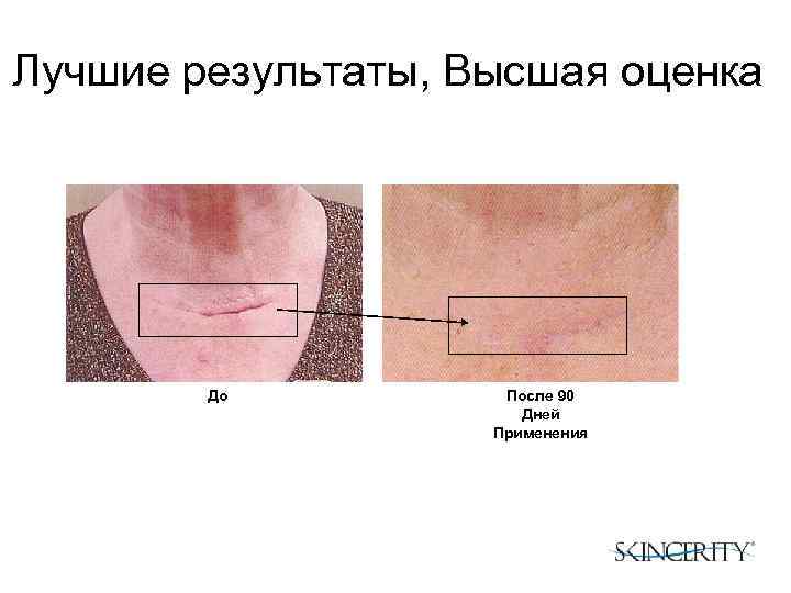 Лучшие результаты, Высшая оценка До После 90 Дней Применения 