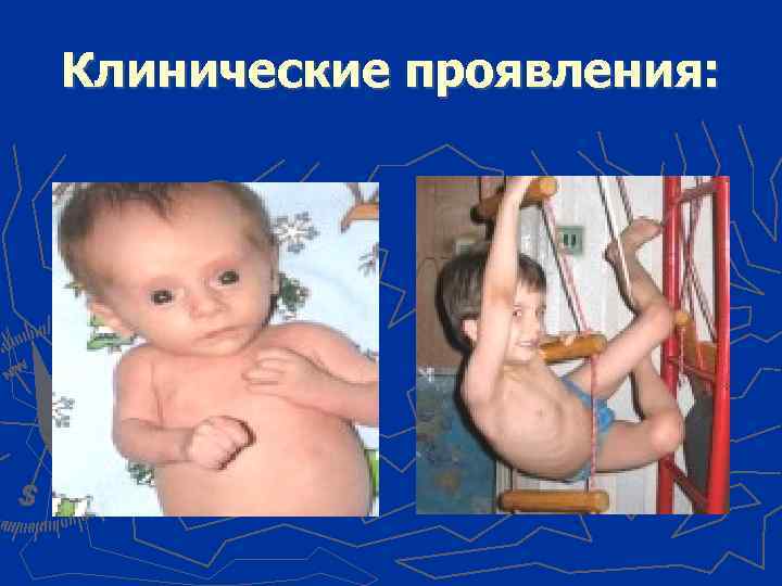 Клинические проявления: 