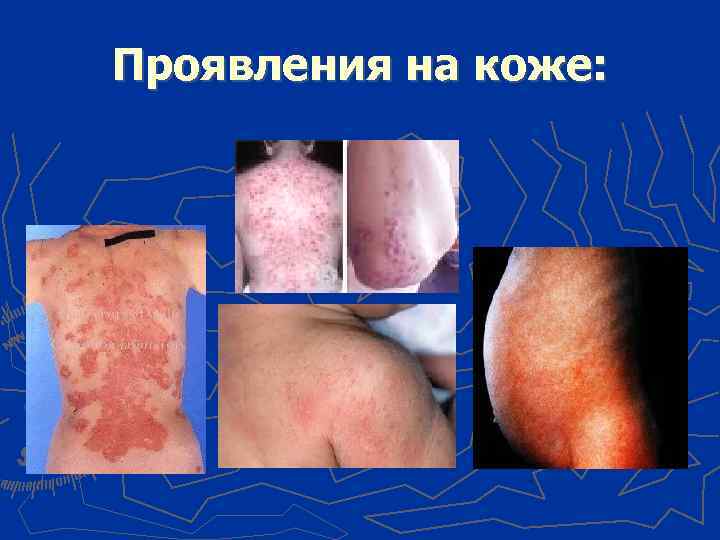 Проявления на коже: 