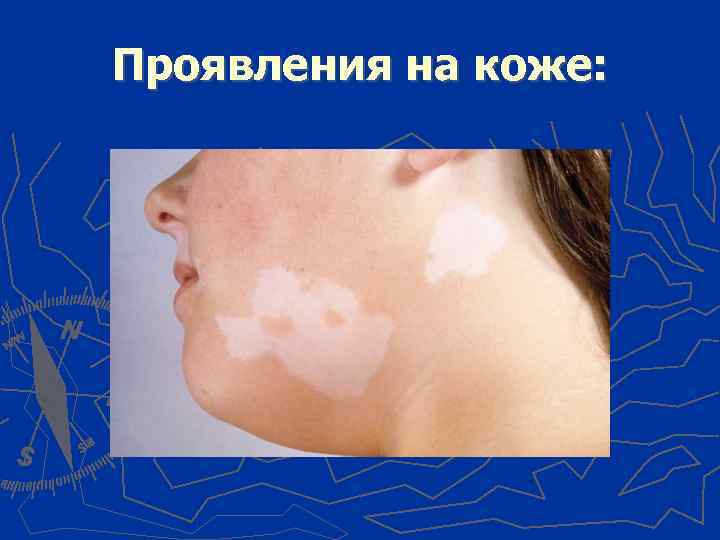 Проявления на коже: 