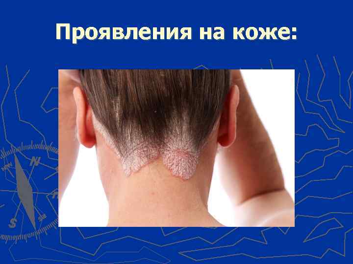 Проявления на коже: 