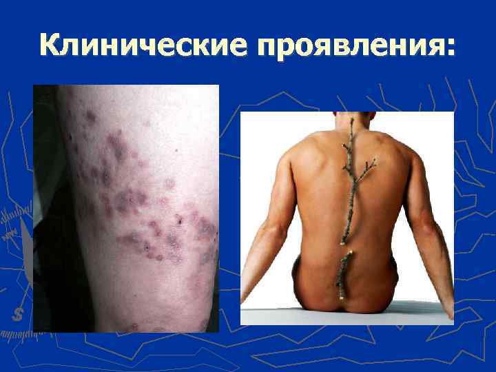 Клинические проявления: 