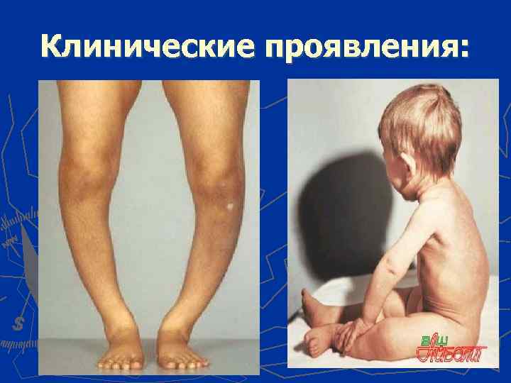 Клинические проявления: 