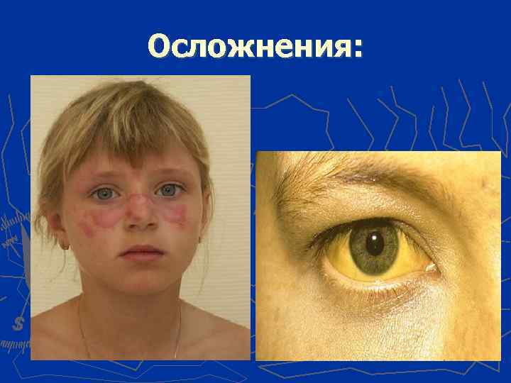 Осложнения: 