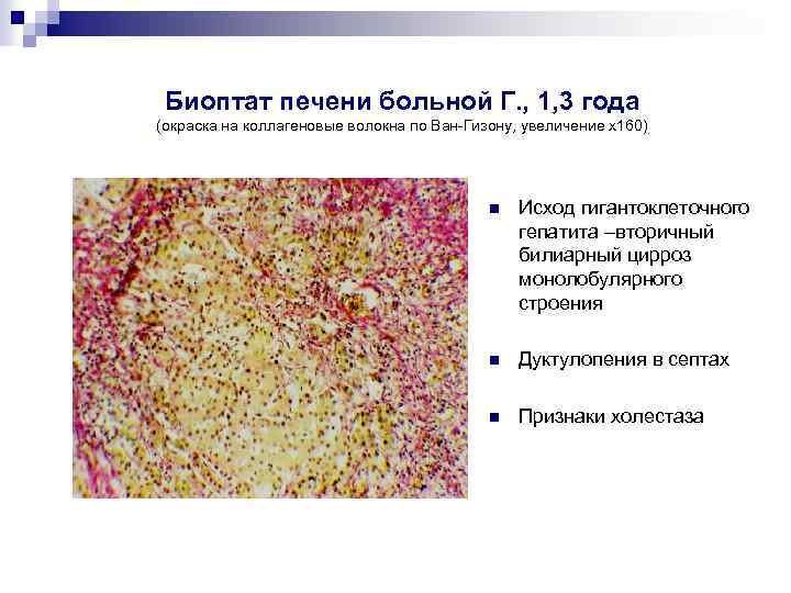Биоптат печени больной Г. , 1, 3 года (окраска на коллагеновые волокна по Ван-Гизону,