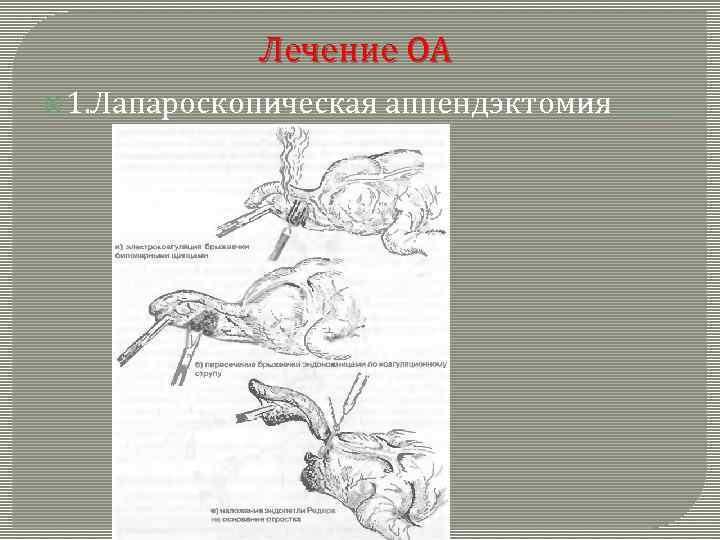 Лечение ОА 1. Лапароскопическая аппендэктомия 