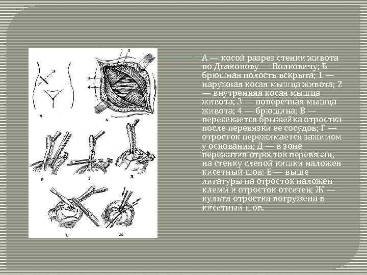  А — косой разрез стенки живота по Дьяконову — Волковичу; Б — брюшная