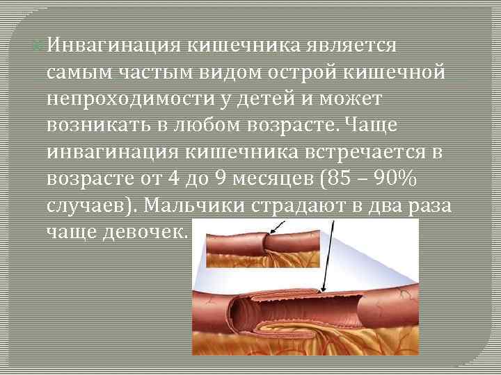  Инвагинация кишечника является самым частым видом острой кишечной непроходимости у детей и может