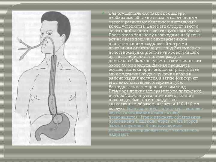  Для осуществления такой процедуры необходимо обильно смазать вазелиновым маслом резиновые баллоны и дистальный