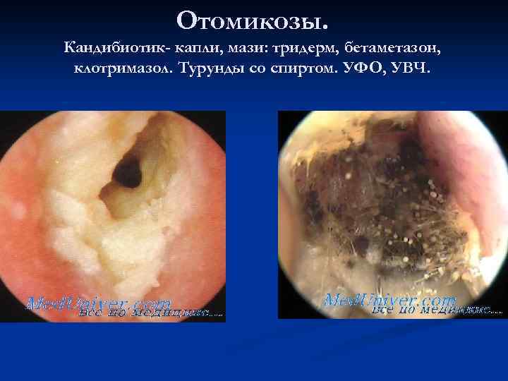 Отомикозы. Кандибиотик- капли, мази: тридерм, бетаметазон, клотримазол. Турунды со спиртом. УФО, УВЧ. 