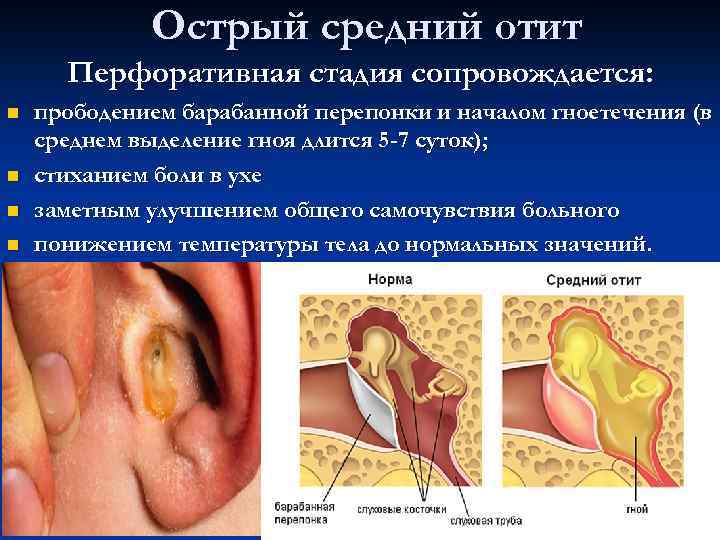 Острый средний отит Перфоративная стадия сопровождается: n n прободением барабанной перепонки и началом гноетечения