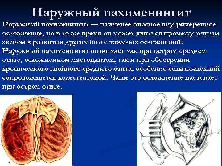 Наружный пахименингит — наименее опасное внутричерепное осложнение, но в то же время он может