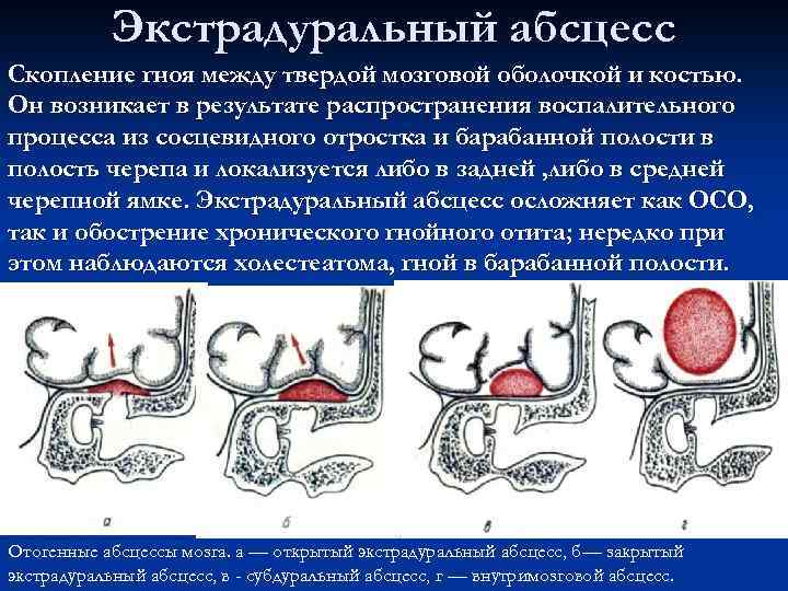 Экстрадуральный абсцесс Скопление гноя между твердой мозговой оболочкой и костью. Он возникает в результате