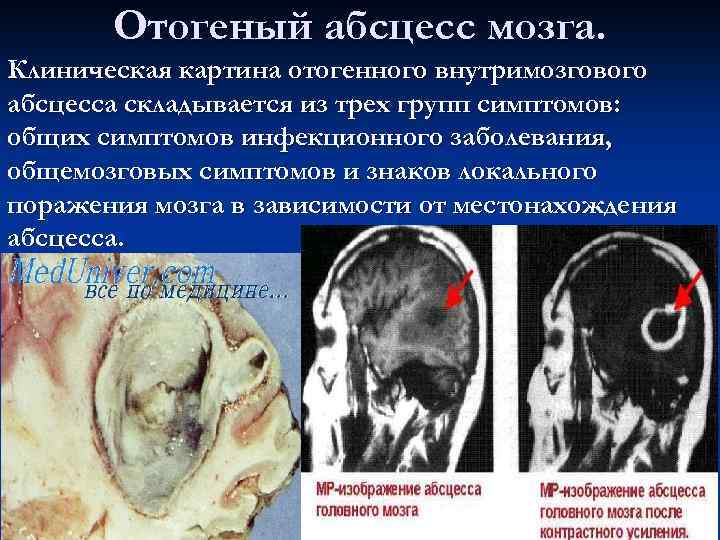 Отогеный абсцесс мозга. Клиническая картина отогенного внутримозгового абсцесса складывается из трех групп симптомов: общих