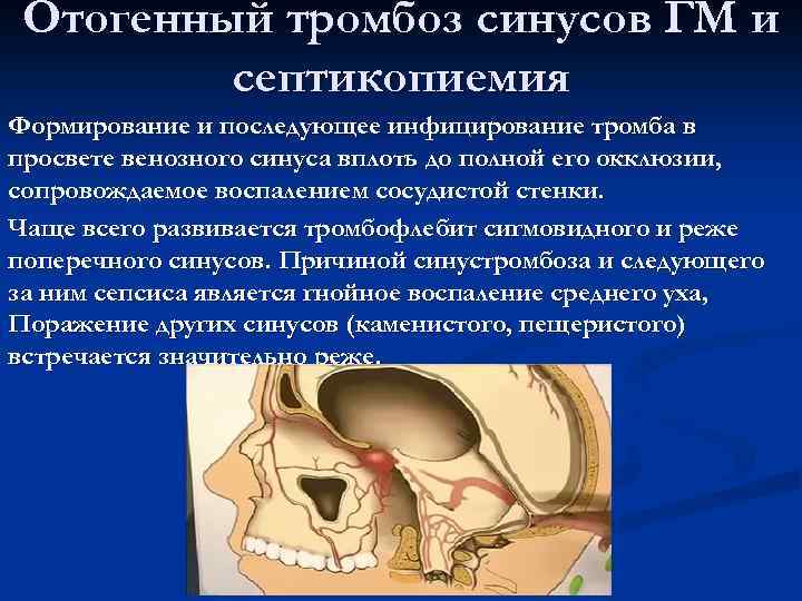 Отогенный тромбоз синусов ГМ и септикопиемия Формирование и последующее инфицирование тромба в просвете венозного