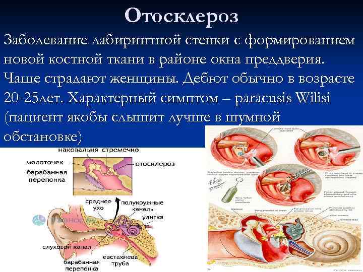 Отосклероз Заболевание лабиринтной стенки с формированием новой костной ткани в районе окна преддверия. Чаще