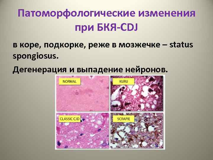 Патоморфологические изменения при БКЯ-CDJ в коре, подкорке, реже в мозжечке – status spongiosus. Дегенерация